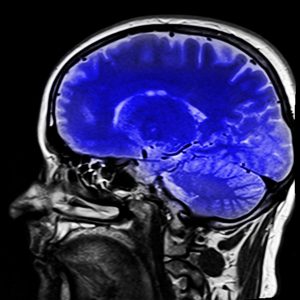 autism study